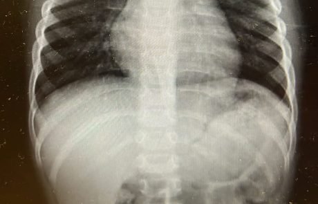 בן 3 בלע סוללה – הובהל בדחיפות לניתוח במרכז הרפואי מאיר