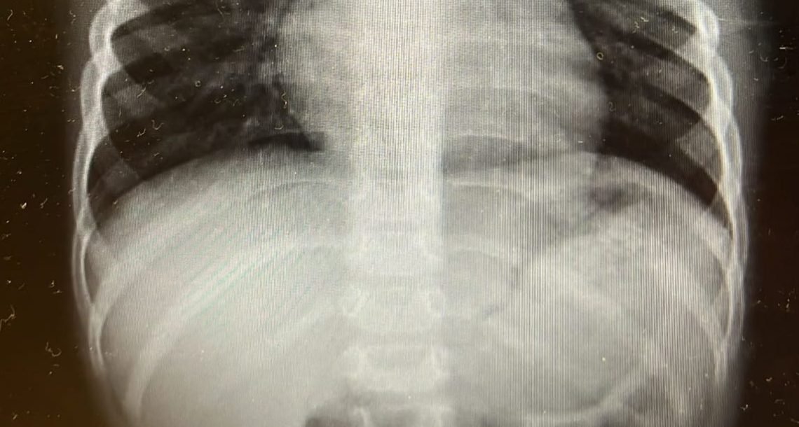 בן 3 בלע סוללה – הובהל בדחיפות לניתוח במרכז הרפואי מאיר